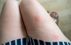 Gerötete Haut mit Insektenstich auf dem Oberschenkel einer Person